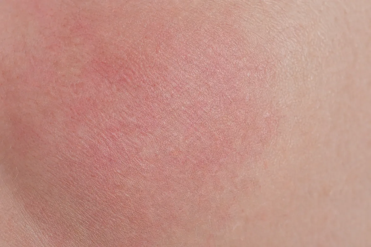 Rougeurs visage : les apaiser sans les camoufler